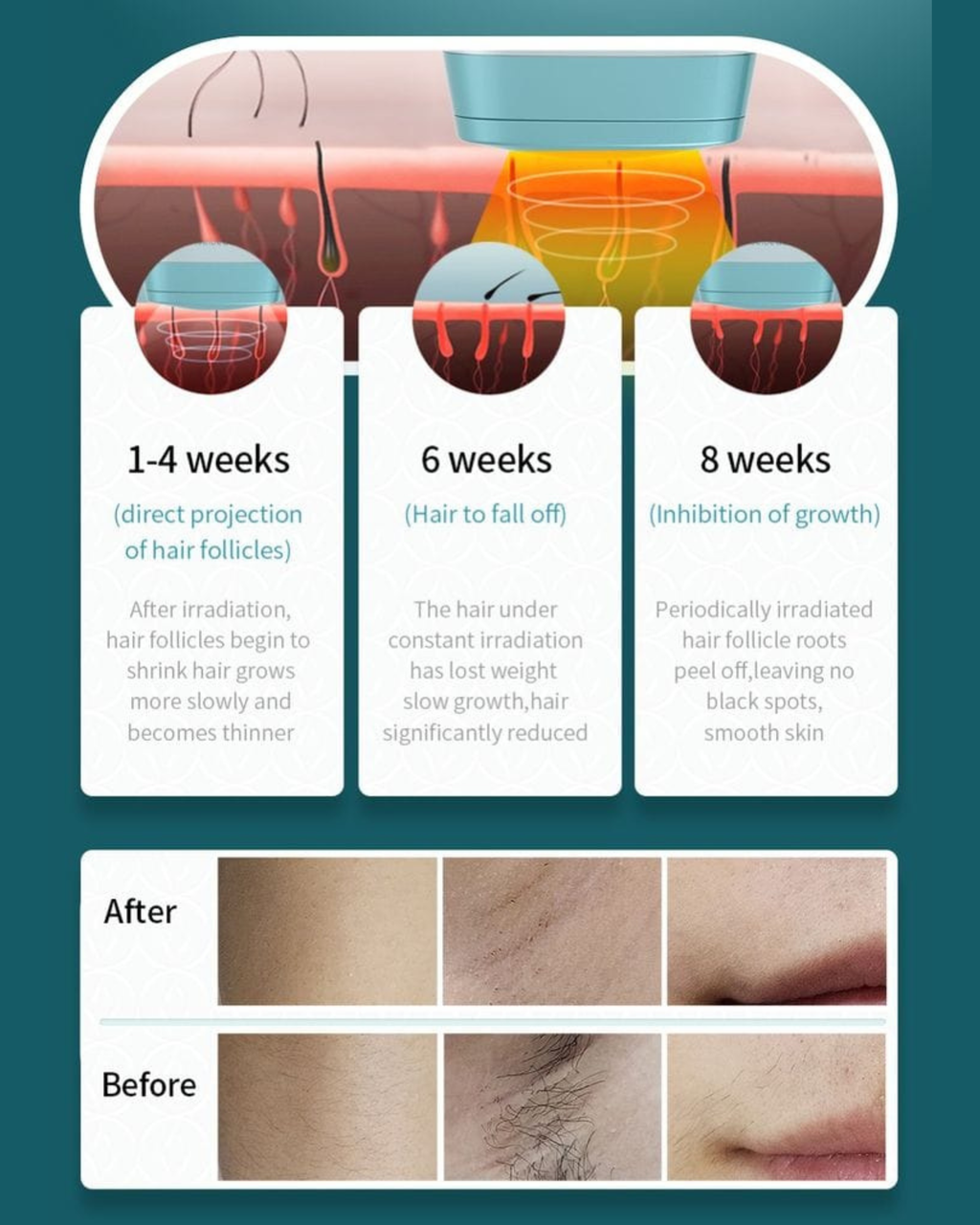 Permanent Hair Removal Device